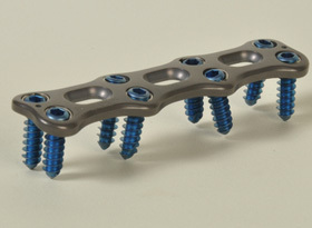 Anterior Cervical Plating System Anterior Cervical Plating System
