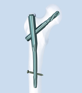 Antirotation Proximal Femoral Nail Antirotation Proximal Femoral Nail
