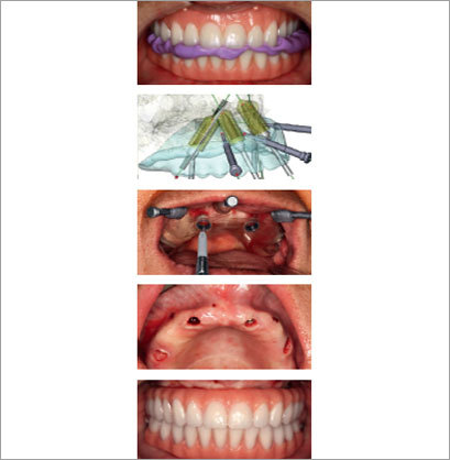 All on 4 Nobel Guide Dental Implant Surgery All on 4 Nobel Guide Dental Implant Surgery