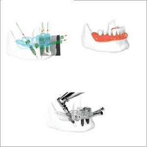 Computer Guided All on 4 Dental Implants Computer Guided All on 4 Dental Implants