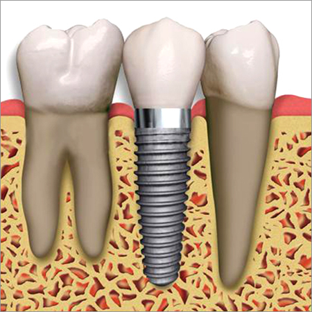 Dental Implants Dental Implants