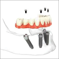 All on 4 Dental Implants All on 4 Dental Implants