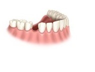Dental Implants for Missing Single Tooth Dental Implants for Missing Single Tooth