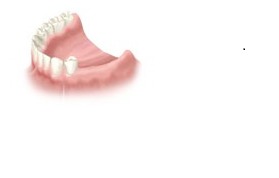 Dental Implants for Several Missing Teeth Dental Implants for Several Missing Teeth