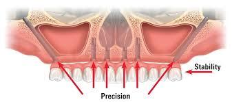 Zygoma Implants Zygoma Implants