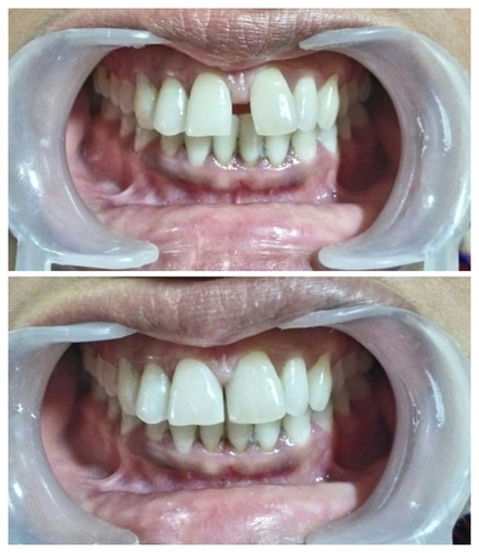 Cosmetic Dentistry Before & After Pictures Cosmetic Dentistry Before & After Pictures
