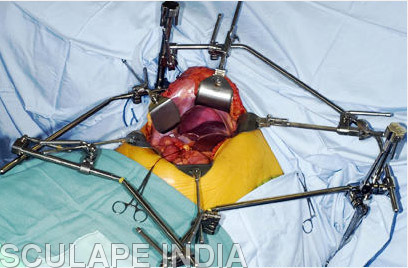 lateral Retractor System lateral Retractor System