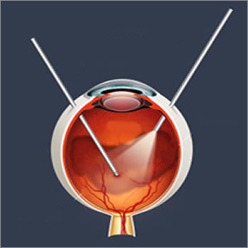 Vitrectomy Equipment Vitrectomy Equipment